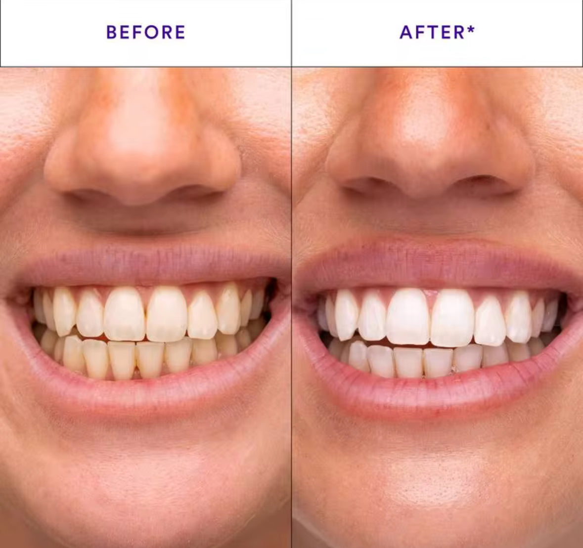 Hismile Teeth Whitening Strips